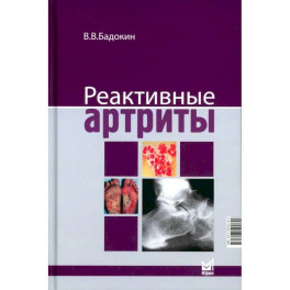 Реактивные артриты. Урогенитальные и постэнтероколитические